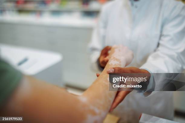 nahaufnahme einer unkenntlichen apothekerin, die vitiligo an der hand einer kundin in einer apotheke überprüft - vitiligo stock-fotos und bilder