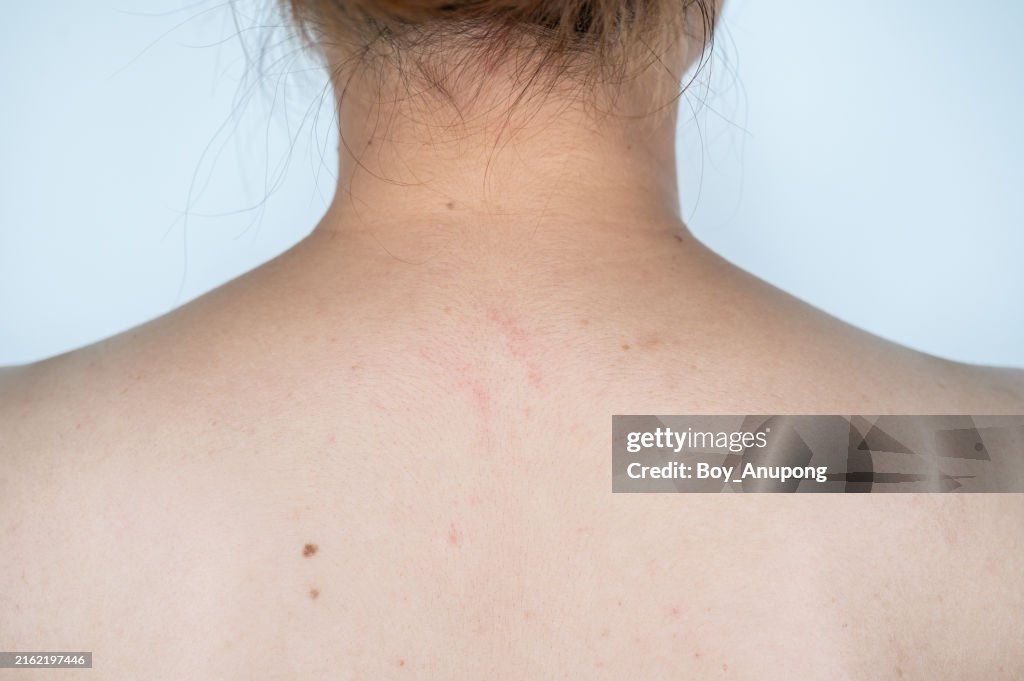 Rear view of acne occur on women back. This happens when pores become clogged with oil, dead skin cells, and bacteria.