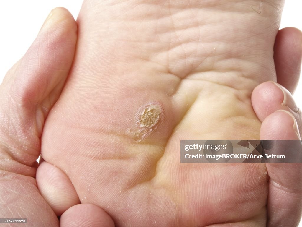 Translate Calluses Callus from wedding ring | Beachweddingtips.com