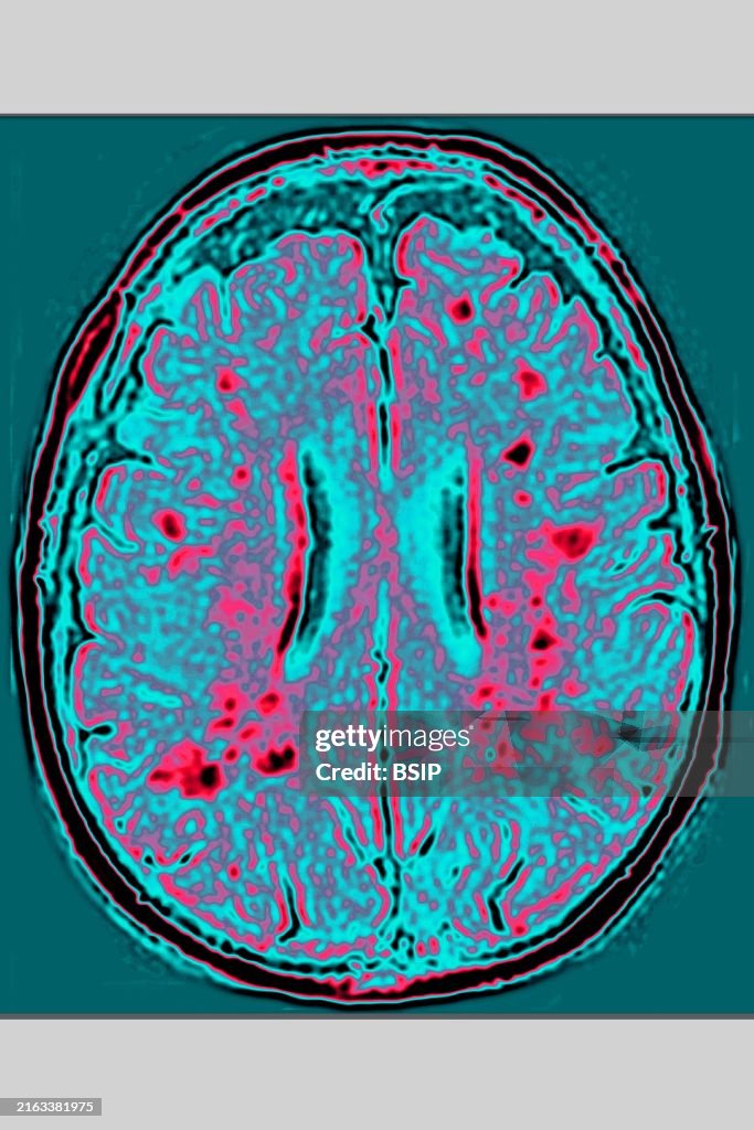 Leukoaraiosis