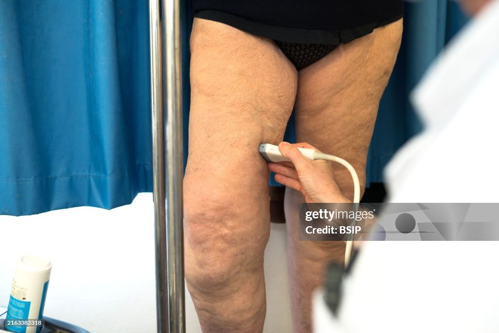 Treatment of varicose veins by foam echosclerotherapy