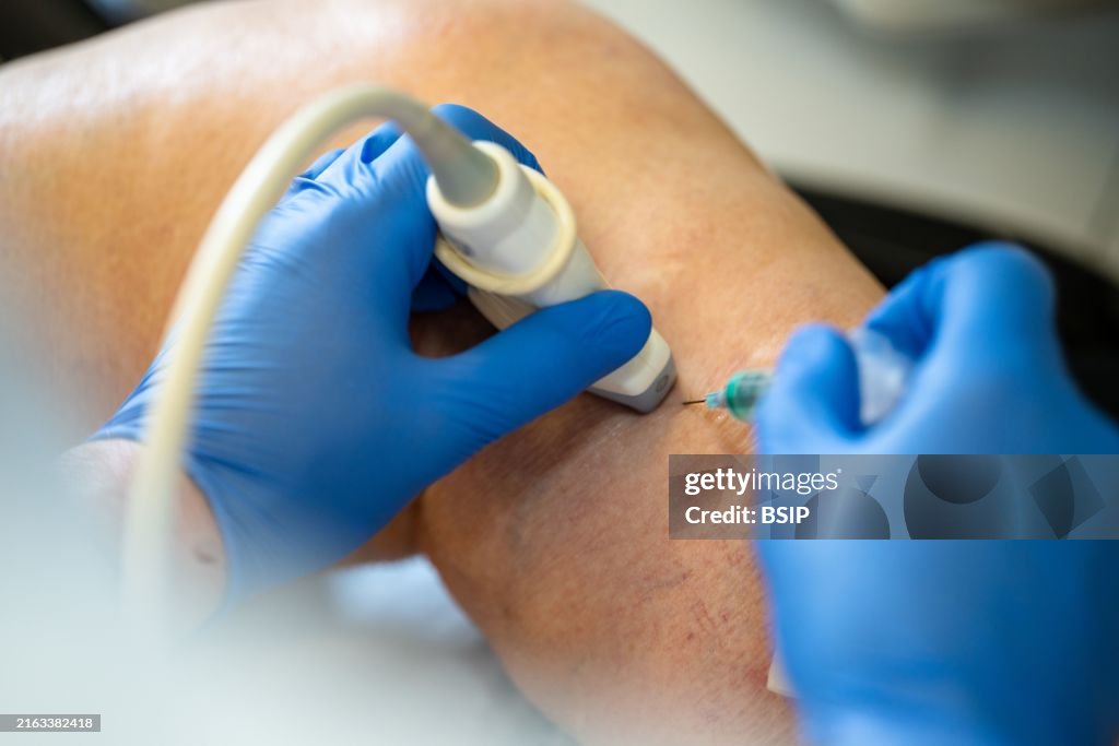 Treatment of varicose veins by foam echosclerotherapy
