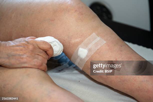 Treatment of varicose veins by foam echosclerotherapy, injection into a target vein of a sclerosing agent in foam form, under ultrasound guidance....