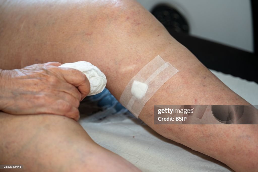 Treatment of varicose veins by foam echosclerotherapy