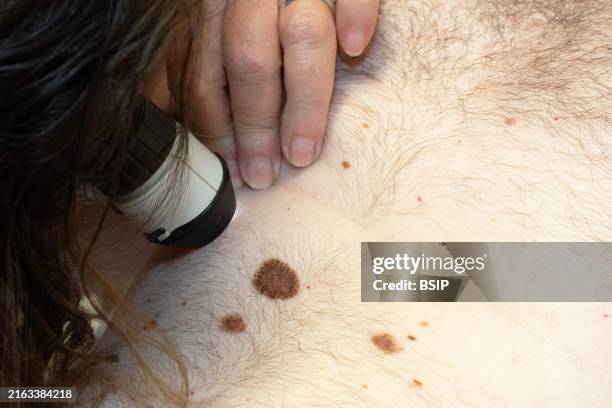 Checking moles on a patient. For the dermatologist, the problem is to distinguish a benign mole from a melanoma, the development of which can be...