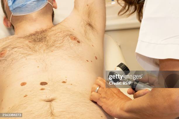 Checking moles on a patient. For the dermatologist, the problem is to distinguish a benign mole from a melanoma, the development of which can be...