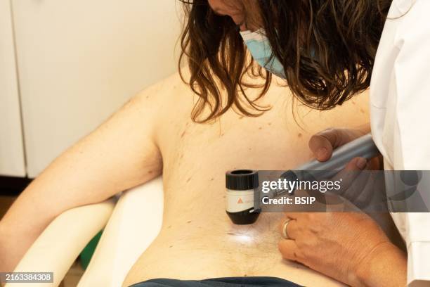 Checking moles on a patient. For the dermatologist, the problem is to distinguish a benign mole from a melanoma, the development of which can be...