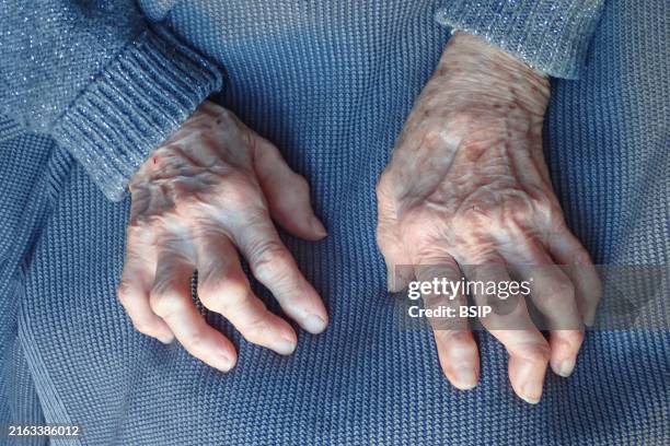 Osteoarthritis.