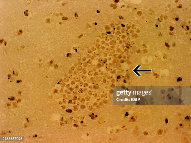Section of the brain of a patient with primary amoebic meningoencephalitis stained with hemotoxylin and eosin showing a large cluster of Naegleria...