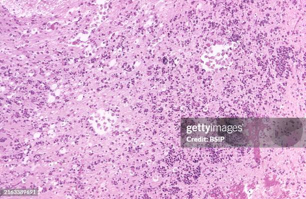 Under a magnification of 125X, this 1973 hematoxylin-eosin -stained photomicrograph revealed the histopathology found in a case of primary amoebic...