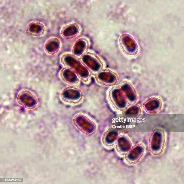 Pneumococcus , pneumococcus is a bacteria involved in pneumonia, bronchopneumonia, purulent pleurisy, bacterial meningitis, otitis, sinusitis, and...