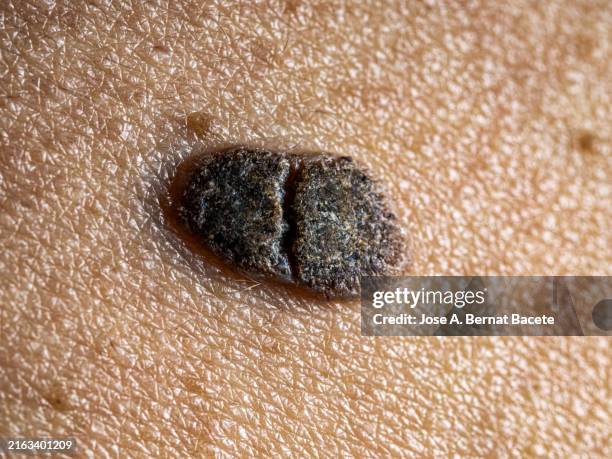 human skin of an adult man with large freckles. - ulcer stock pictures, royalty-free photos & images