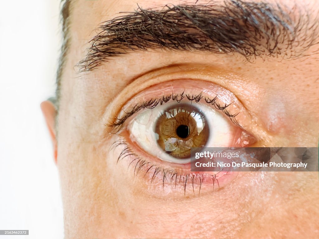 Close-up of man's infected eye with stye called chalazion