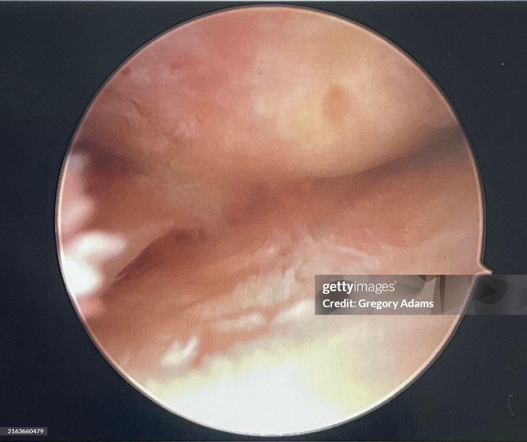 Human Medial Meniscus Before Surgery Viewed during Arthroscopic Knee Surgery