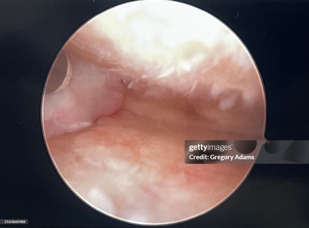 Human Medial Meniscus Before Surgery Viewed during Arthroscopic Knee Surgery