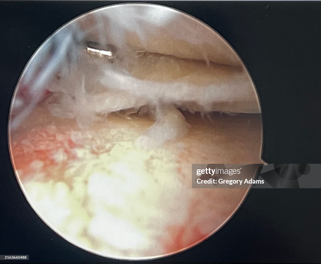 Human Medial Meniscus After Surgery Viewed during Arthroscopic Knee Surgery