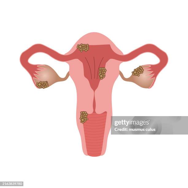 tumoren der eierstöcke und der gebärmutter, eierstock- und gebärmutterkrebs - intimzone stock-grafiken, -clipart, -cartoons und -symbole