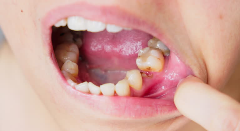 Teeth Rottem 617 Rotten Teeth Stock Videos, Footage, & 4K Video Clips - Getty Images