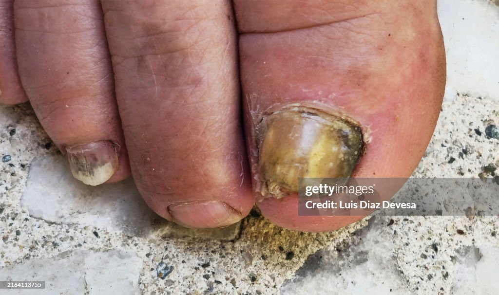 Onychomycosis