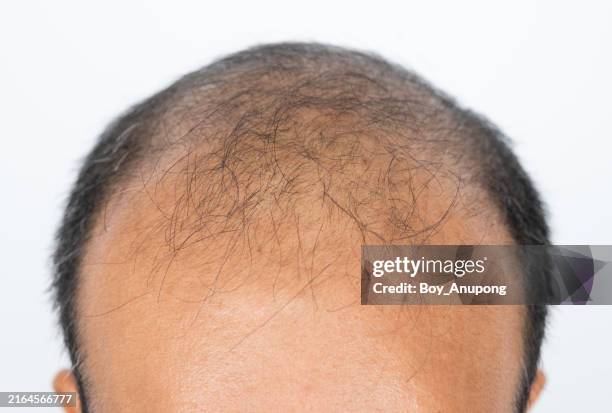 cropped shot view of asian men's scalp with few hairs. baldness is related to your genes and male sex hormones. - calvizie foto e immagini stock