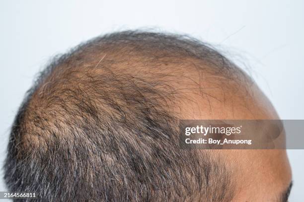 side view of asian men's head with few thin hairs. baldness is related to your genes and male sex hormones. - old man with black hair stock pictures, royalty-free photos & images
