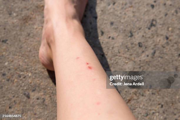 Leg Razor Burn 46 Razor Burn Concept Stock Photos, High-Res Pictures, and Images ...