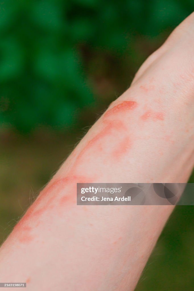 Skin Rash Poison Ivy Rash