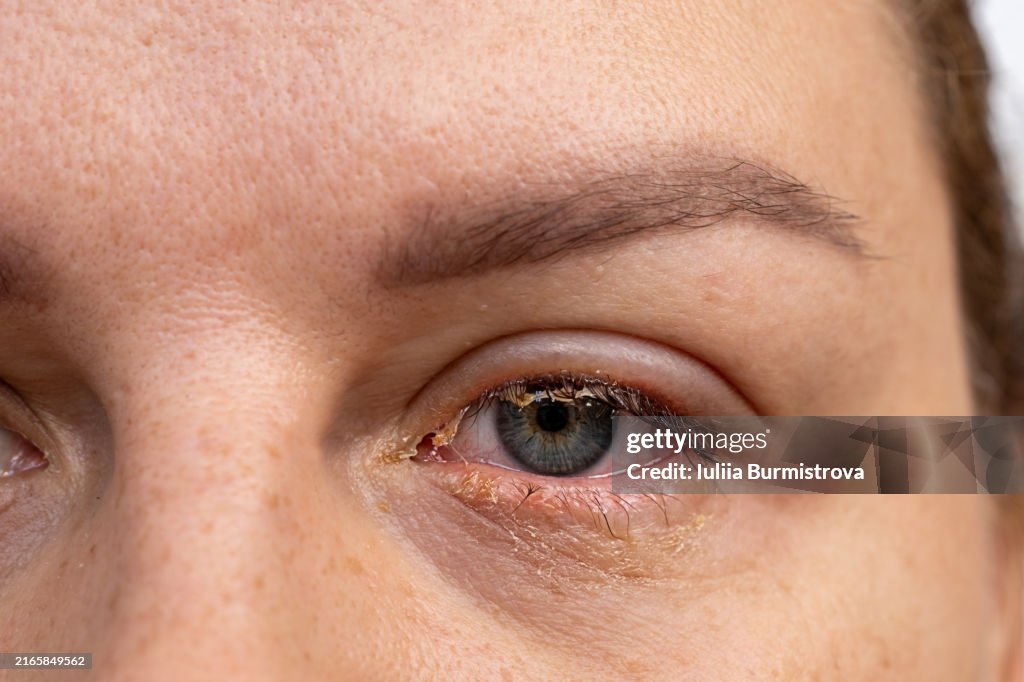 Red eye with pus and infection