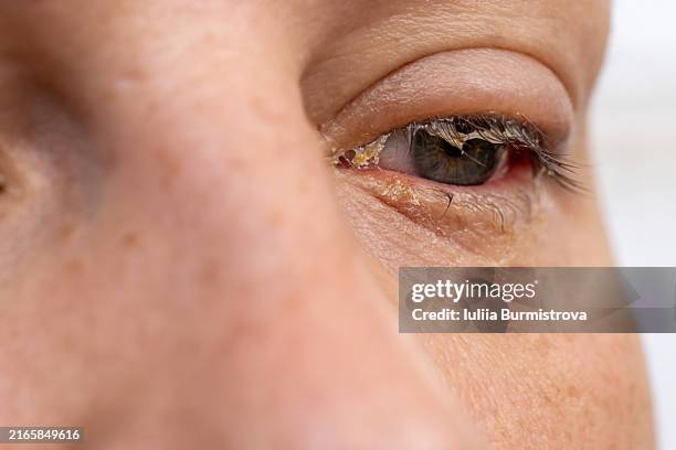 a close-up view of an eye suffering from conjunctivitis - sebaceous gland stock pictures, royalty-free photos & images