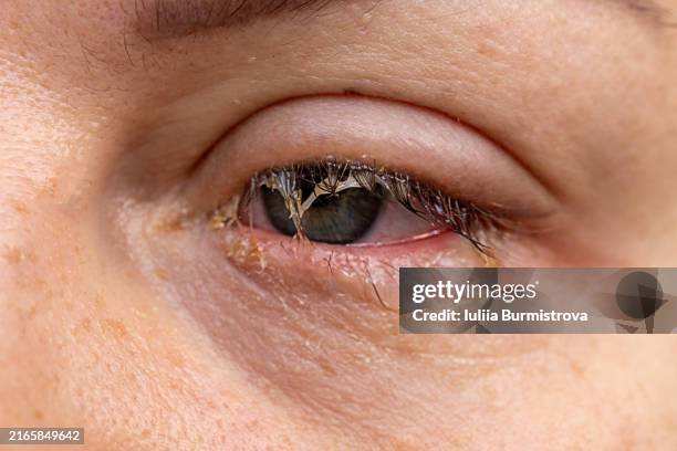uveitis: understanding the signs and symptoms - blepharitis stock pictures, royalty-free photos & images