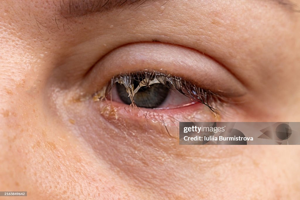Uveitis: understanding the signs and symptoms