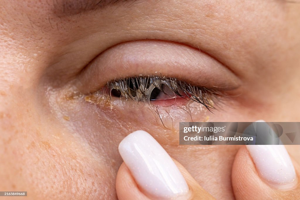 A close up woman eye suffering from bacterial conjunctivitis, causing teary eyes and weeping crusty pus, fighting infection