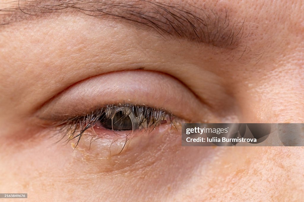 An eye with bacterial purulence conjunctivitis, also known as pink eye