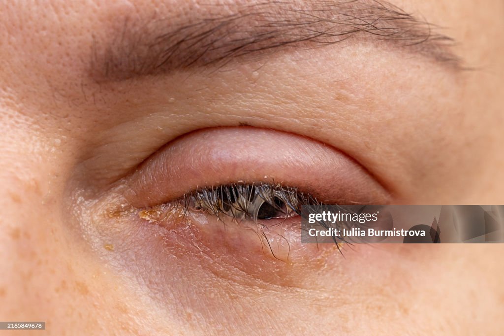 Eye Infection Symptoms