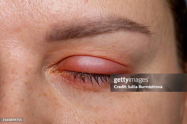 swelling and redness associated with hordeolum - hinchado-inflamación fotografías e imágenes de stock