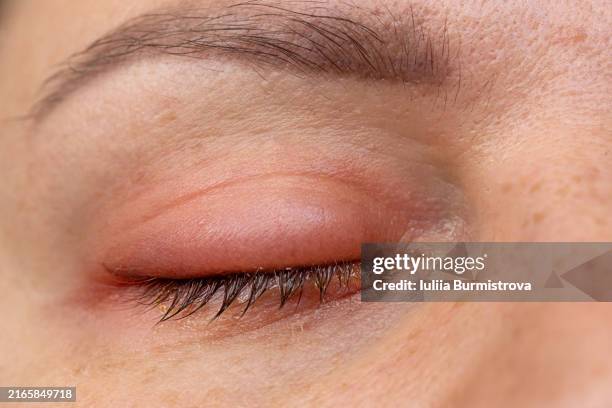 inflamed eye provides insight into the visible symptoms of bacterial eye infections - hinchado-inflamación fotografías e imágenes de stock