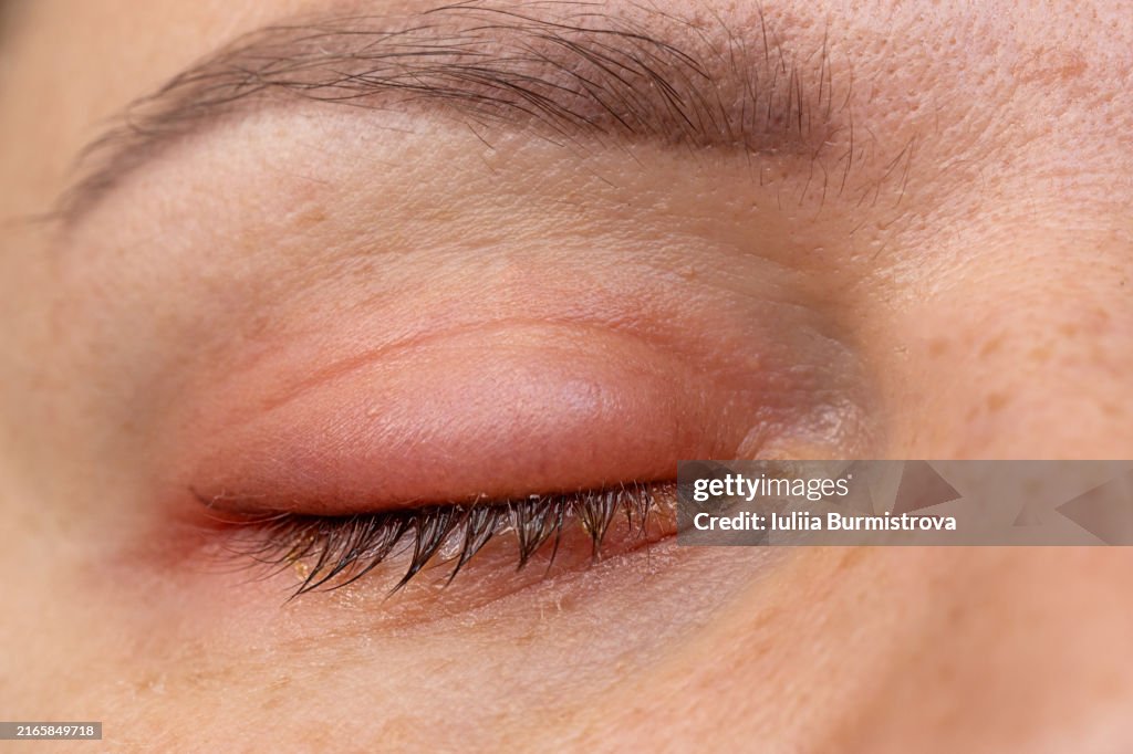 Inflamed eye provides insight into the visible symptoms of bacterial eye infections