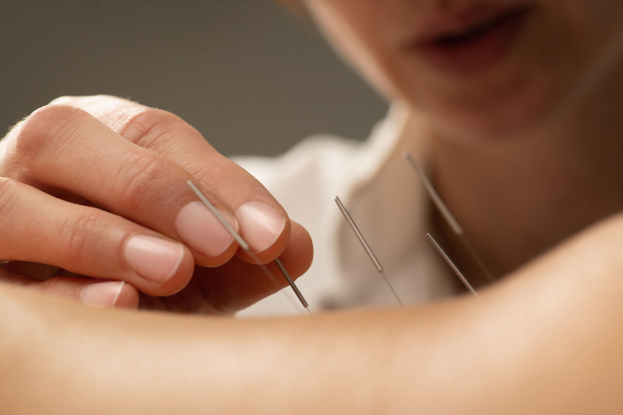 acupuncture therapy
