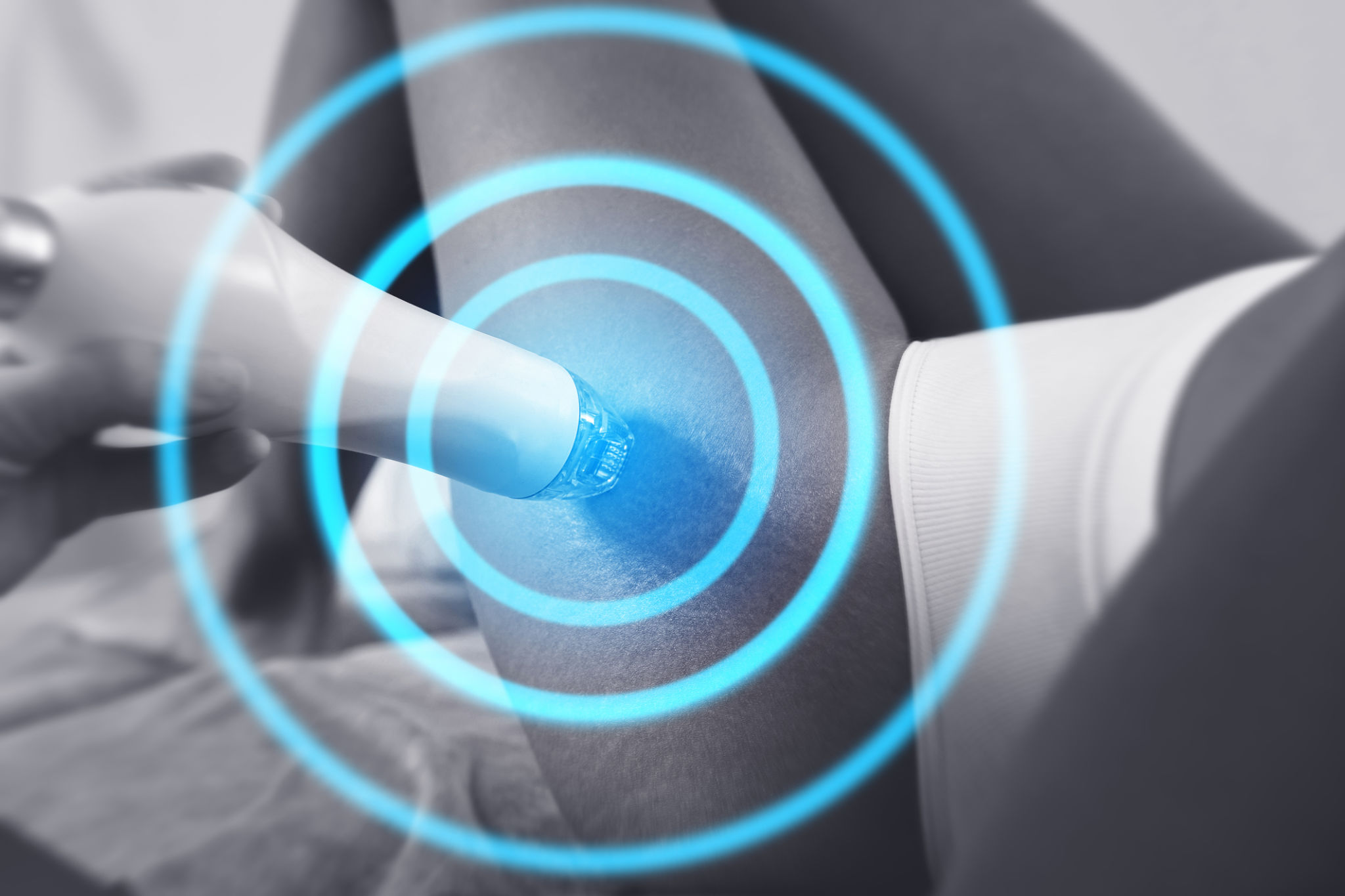 Radio frequency (RF) skin resurfacing treatment for stretching marks removal in a medical aesthetic clinic Radio frequency (RF) skin resurfacing treatment for stretching marks removal in a medical aesthetic clinic