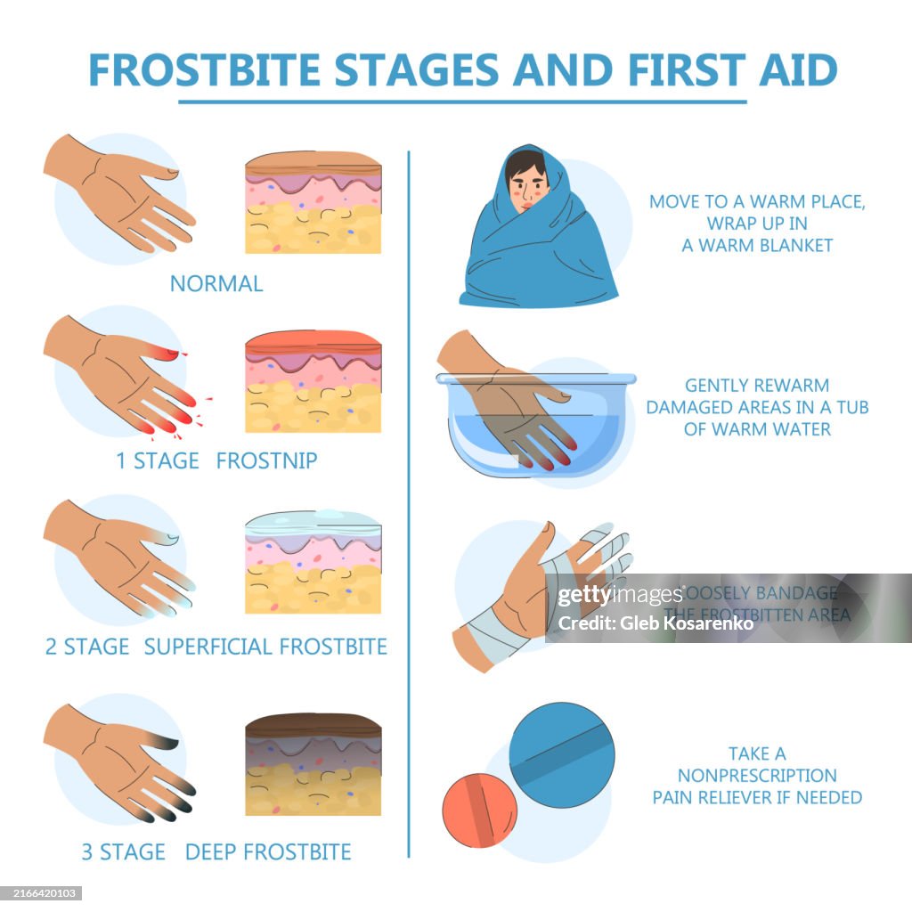 Forstbite Chart Frostbite Infographic First Aid And Stages High-Res Vector Graphic ...