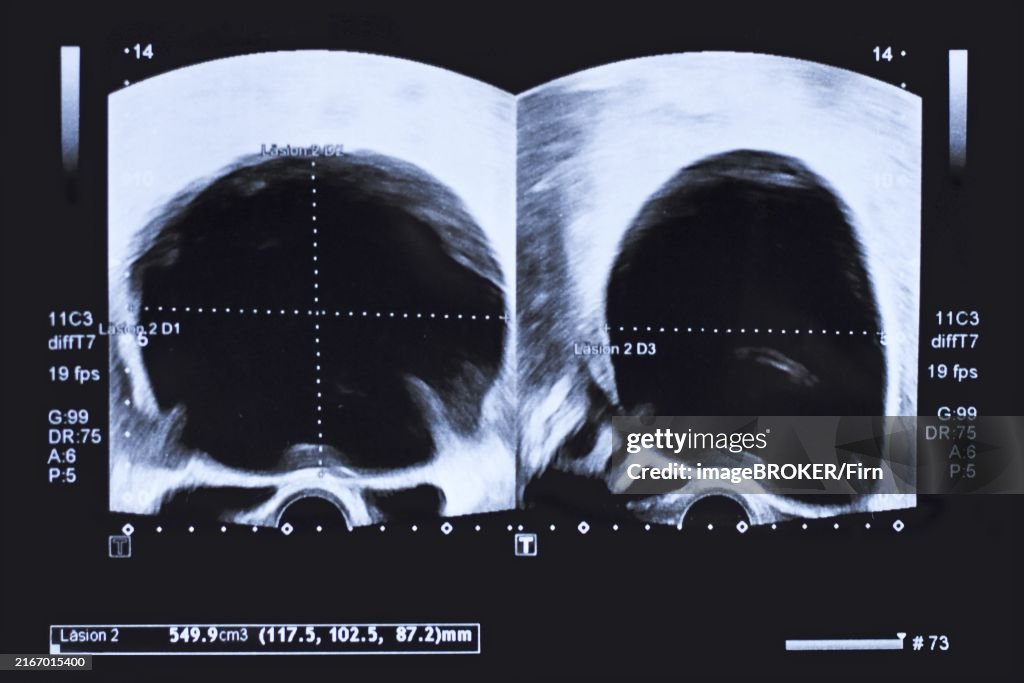 Ultrasound image of large round cyst in lower abdomen of woman printed on a piece of paper