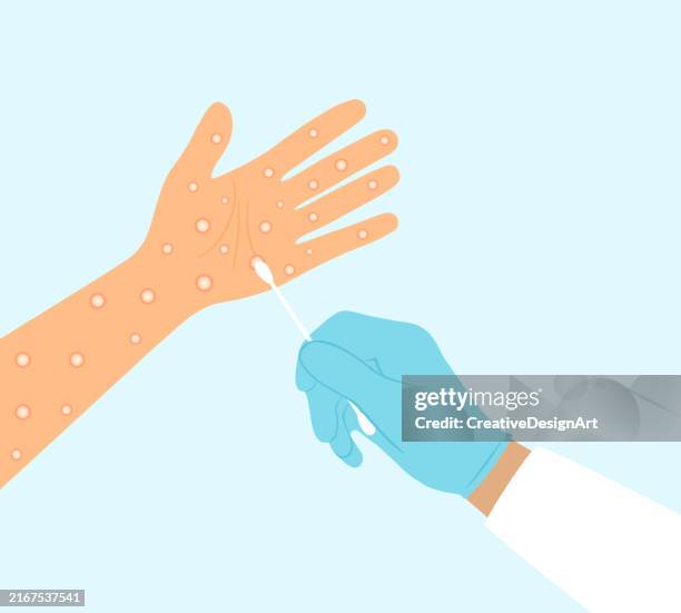 close-up of patient hand with monkeypox rash. doctor hand in medical gloves taking viral swab from lesions. diagnosis of monkeypox virus - varicella zoster virus stock illustrations