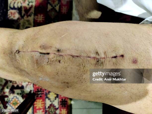 medical stiches on human knee and leg after successful knee replacement incision or operation. - schnittwunde stock-fotos und bilder