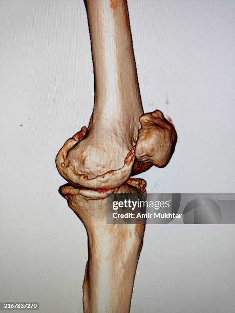 arthroscopic transtibial tunnel posterior cruciate ligament reconstruction of human knee. - cartílago fotografías e imágenes de stock