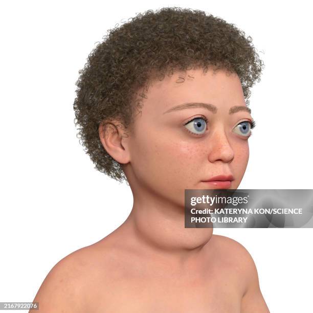 child with graves' disease, illustration - endocrine system stock illustrations