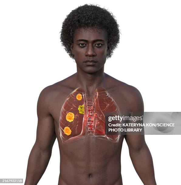 pulmonary blastomycosis, illustration - distorted body stock illustrations