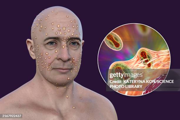 Men Face Rash 92 Man With Rash On Face Stock Photos, High-Res Pictures, and Images ...