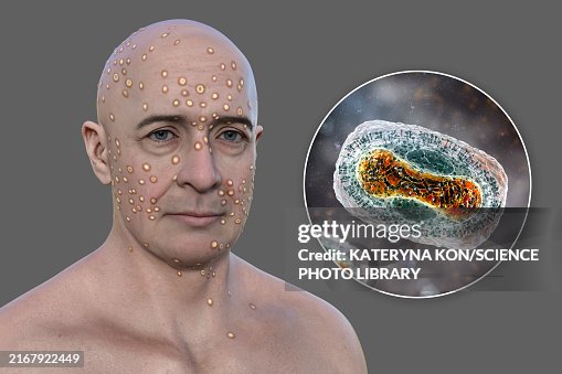 Man With Rash From Pox Virus Infection Illustration High-Res Vector ...