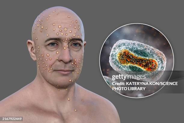 22 Smallpox Rash Stock Photos, High-Res Pictures, and Images - Getty Images