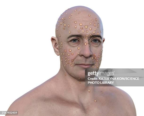 Men Face Rash 92 Man With Rash On Face Stock Photos, High-Res Pictures, and Images ...